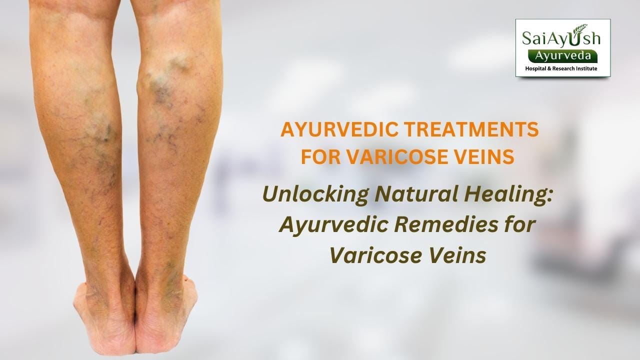 Ayurvedic treatments for varicose veins